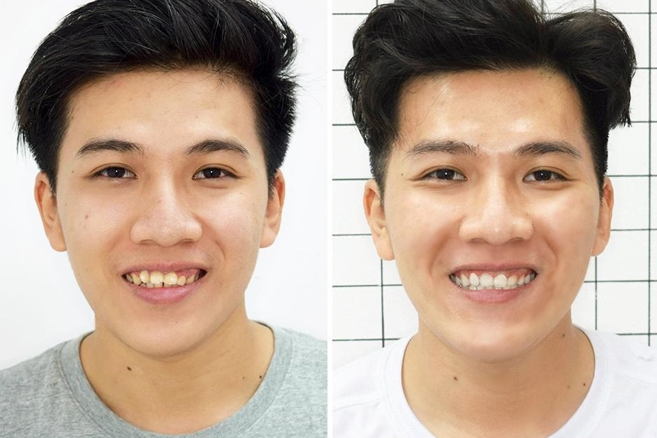 niềng răng tại Up Dental ảnh 2 nieng rang tai Up Dental anh 2