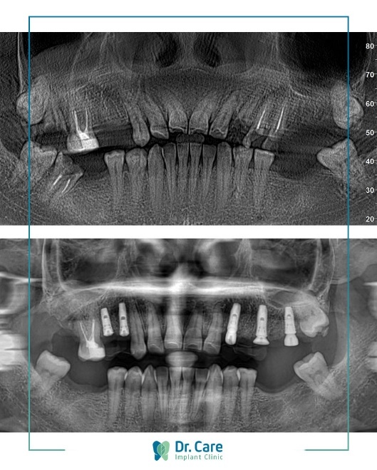 Trong rang Implant anh 3