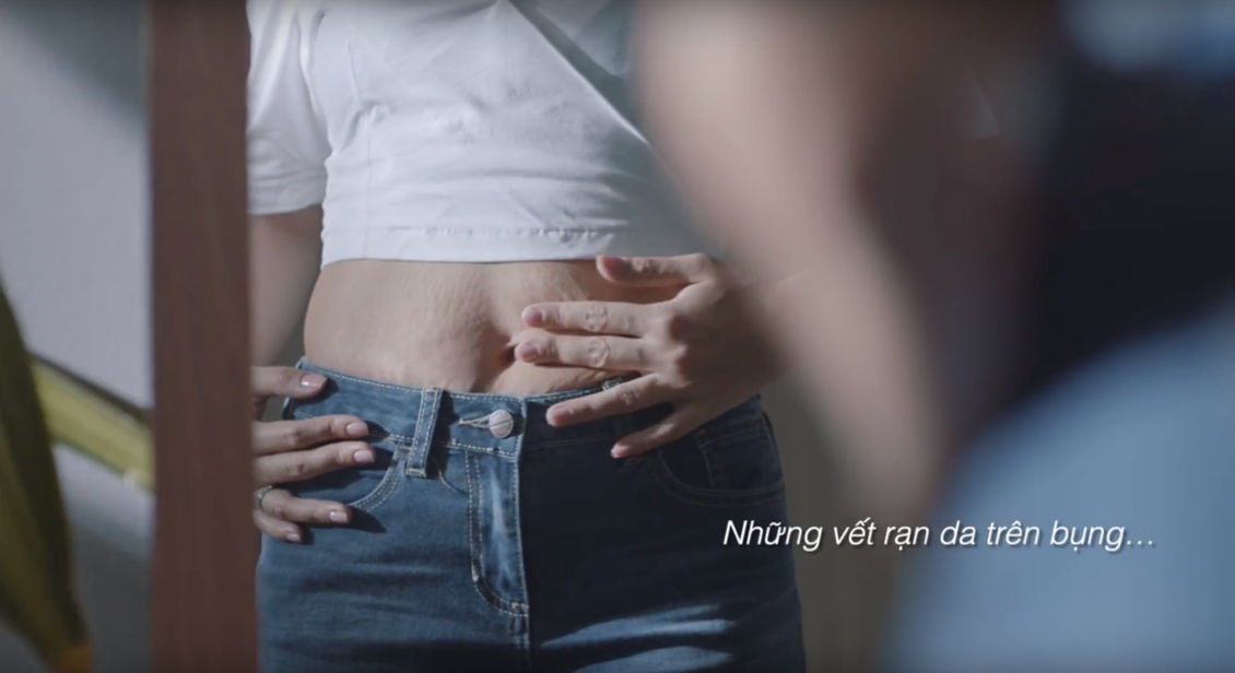 vết rạn da,  sẹo tâm lý ảnh 2 vet ran da,  seo tam ly anh 2