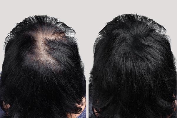 cach ngan rung toc anh 2