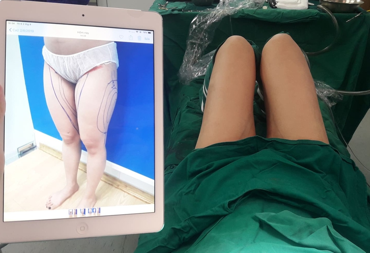 Hút mỡ có bị béo lại ảnh 2 Hut mo co bi beo lai anh 2