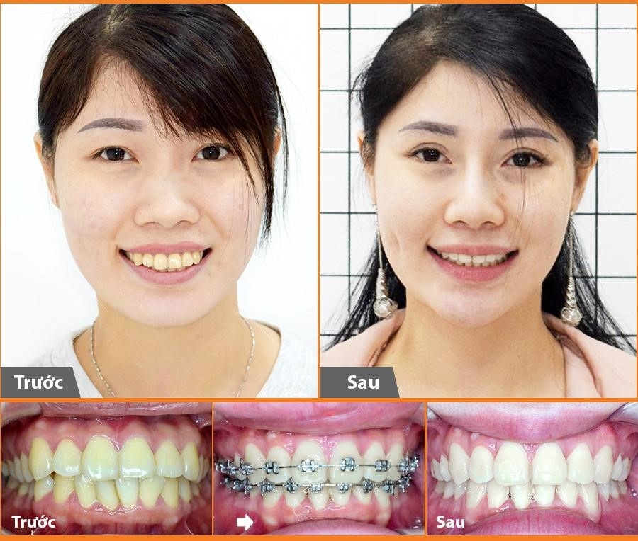 Nieng rang co dau khong anh 2