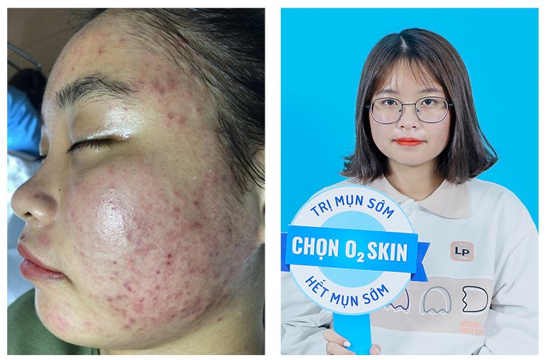 cham soc da mun anh 1