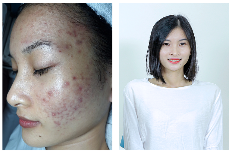 cham soc da mun anh 3