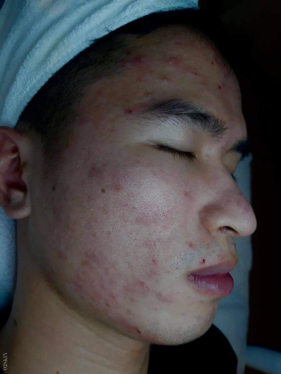 O2 Skin anh 1