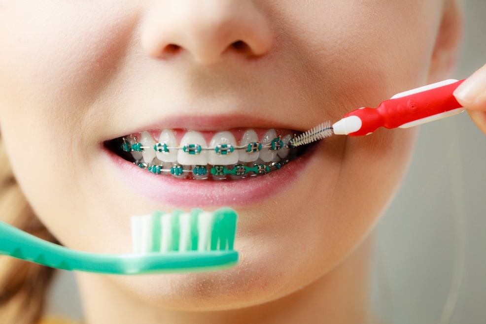 giữ vệ sinh khi niềng răng ảnh 1 giu ve sinh khi nieng rang anh 1