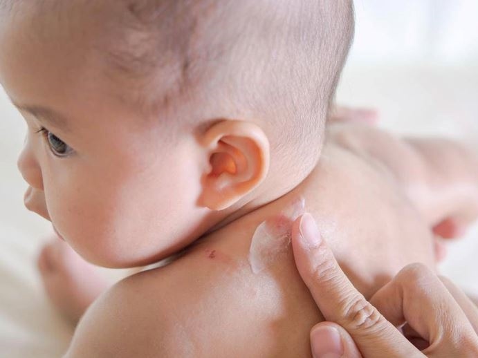 Kem thao duoc ho tro ngua ham ta, rom say cho be hinh anh