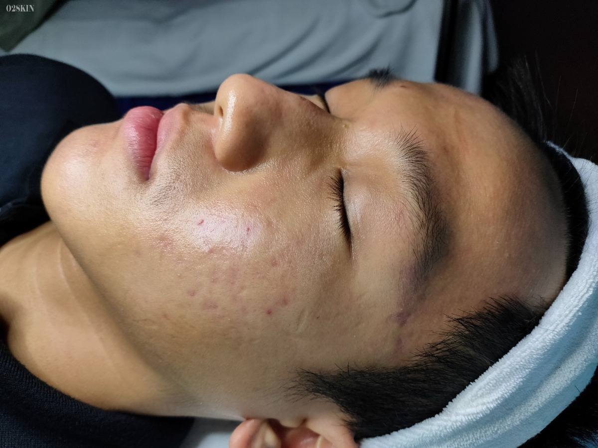 Dieu tri mun boc anh 2