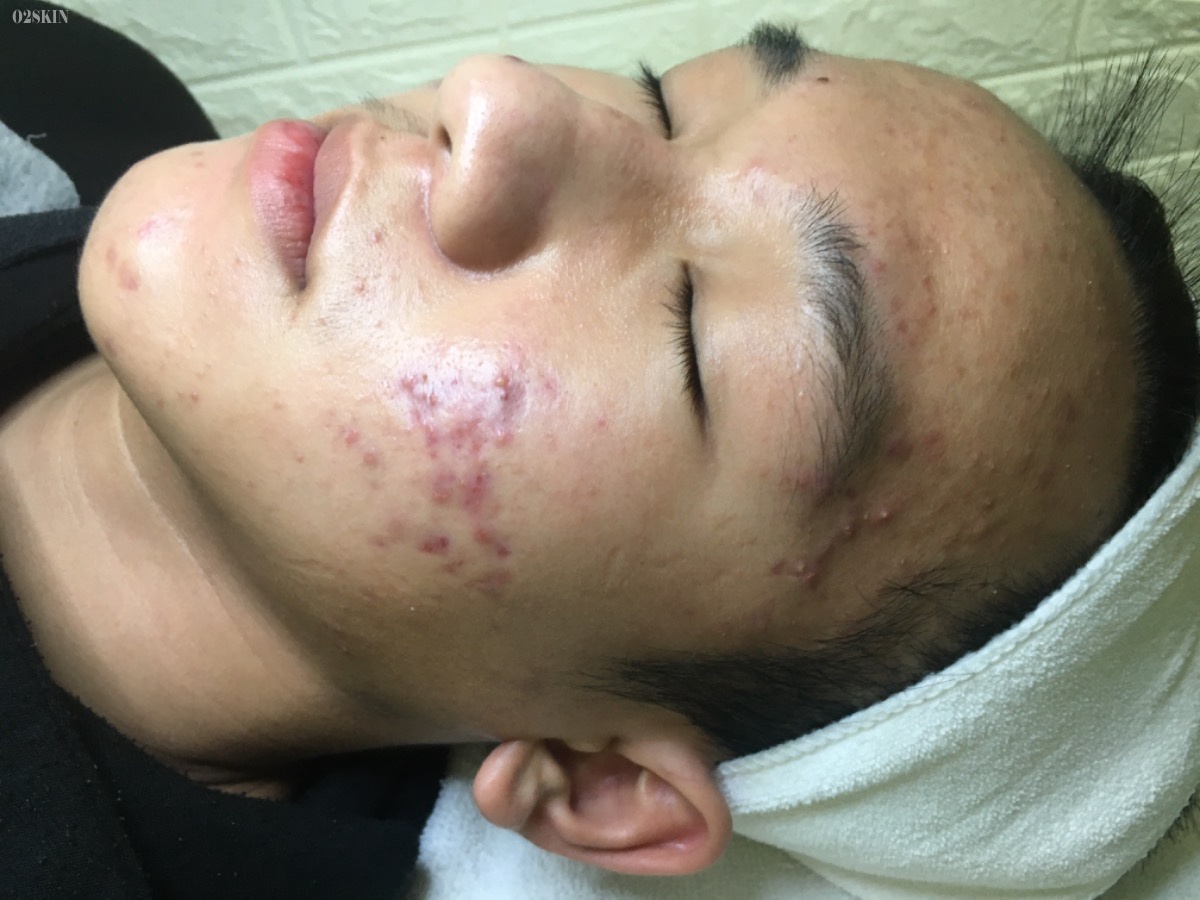 Dieu tri mun boc anh 1