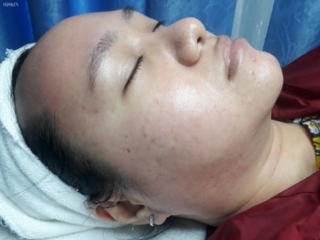 O2 Skin ảnh 2 O2 Skin anh 2