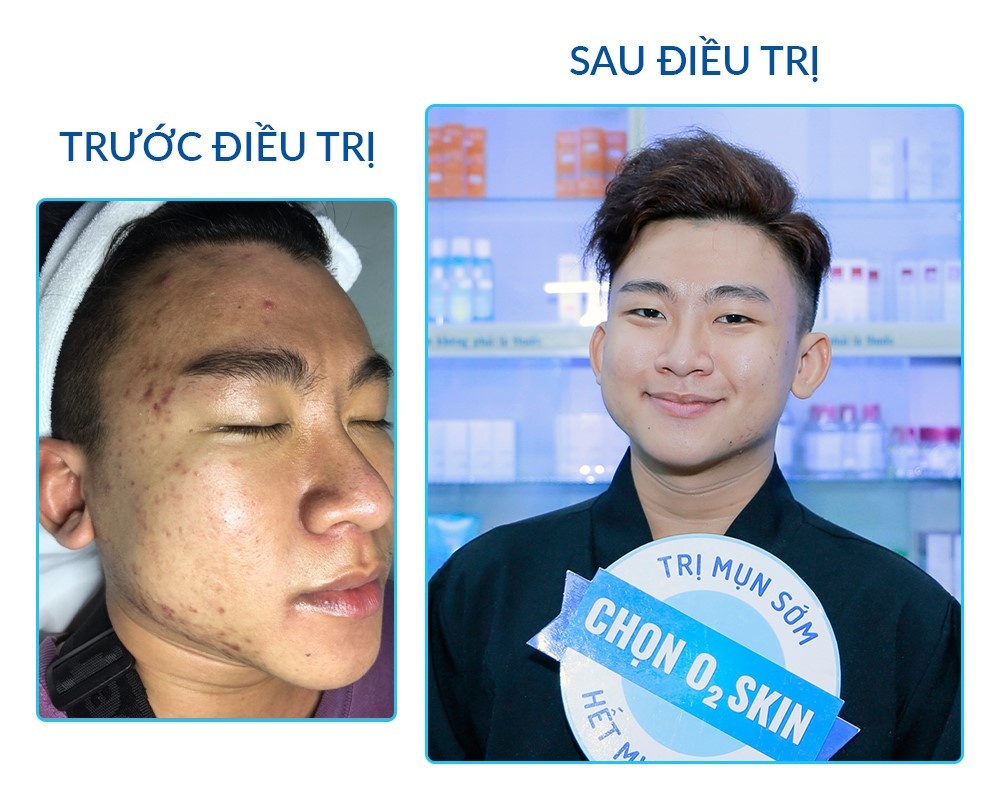 O2 Skin anh 4