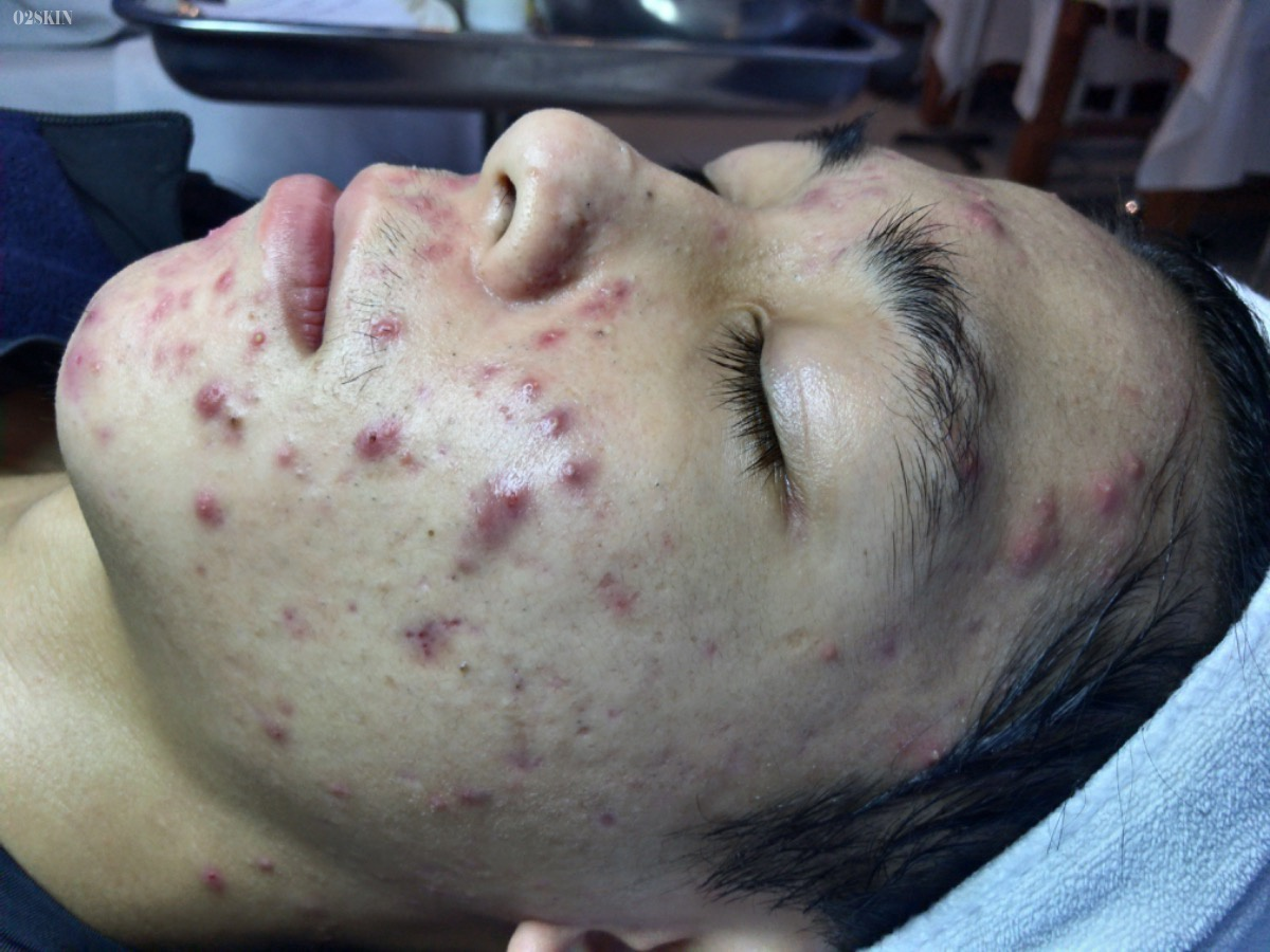 O2 Skin ảnh 1 O2 Skin anh 1