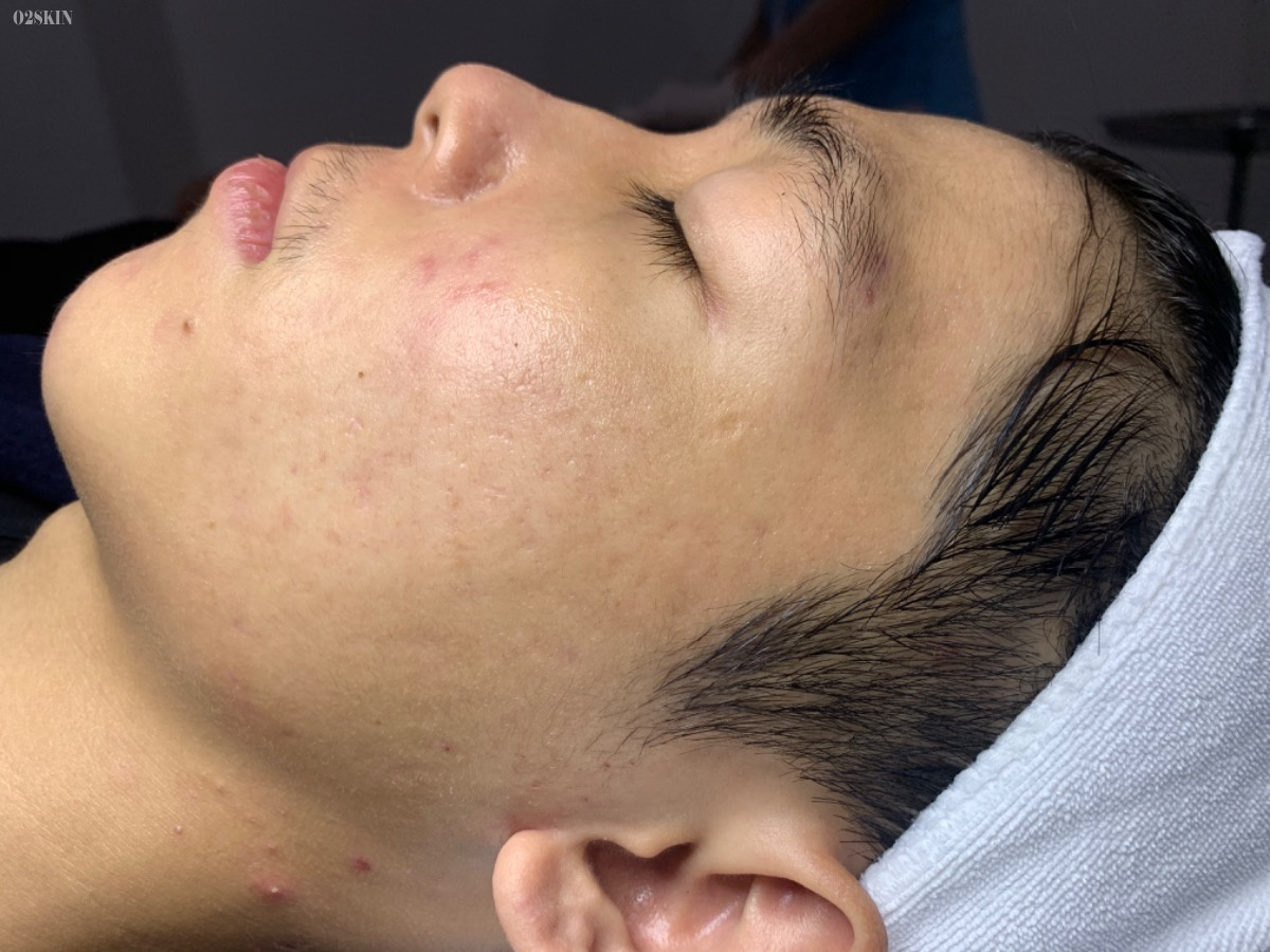 O2 Skin ảnh 2 O2 Skin anh 2