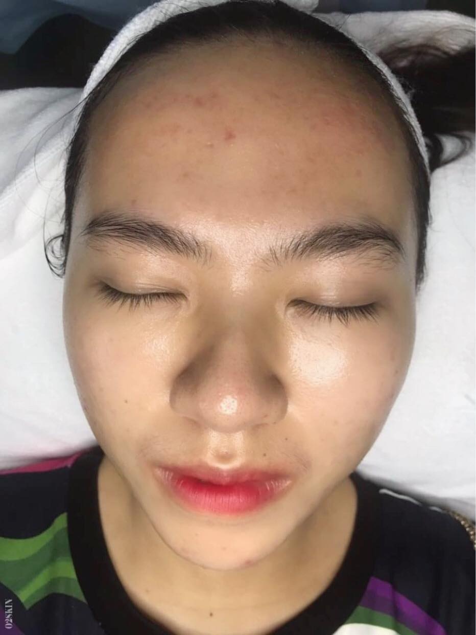 Điều trị mụn ảnh 3 Dieu tri mun anh 3