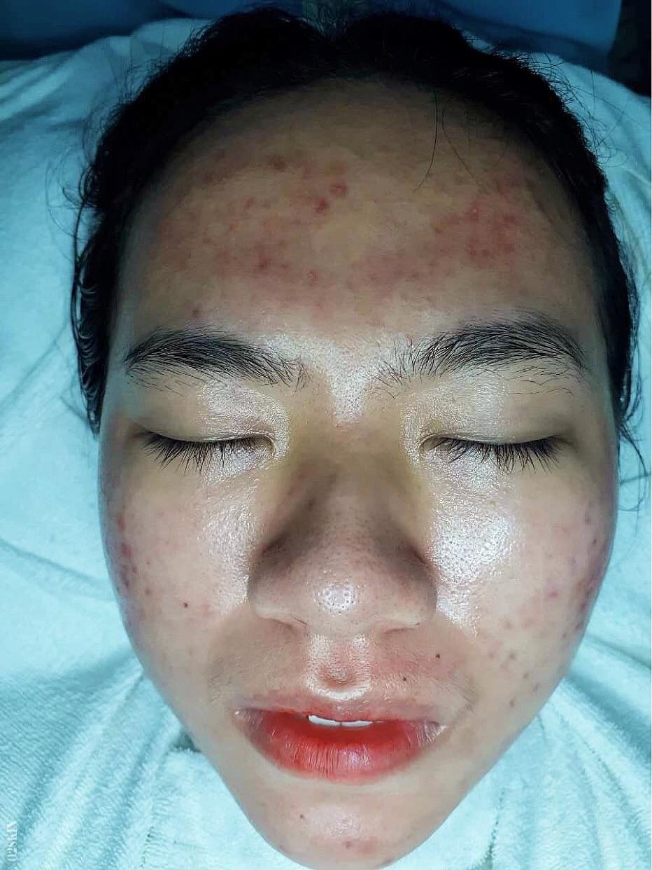 Điều trị mụn ảnh 2 Dieu tri mun anh 2