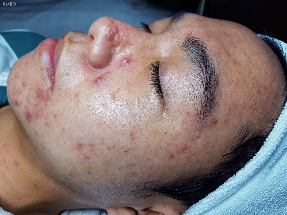 dieu tri mun bang phac do ca nhan hoa anh 1