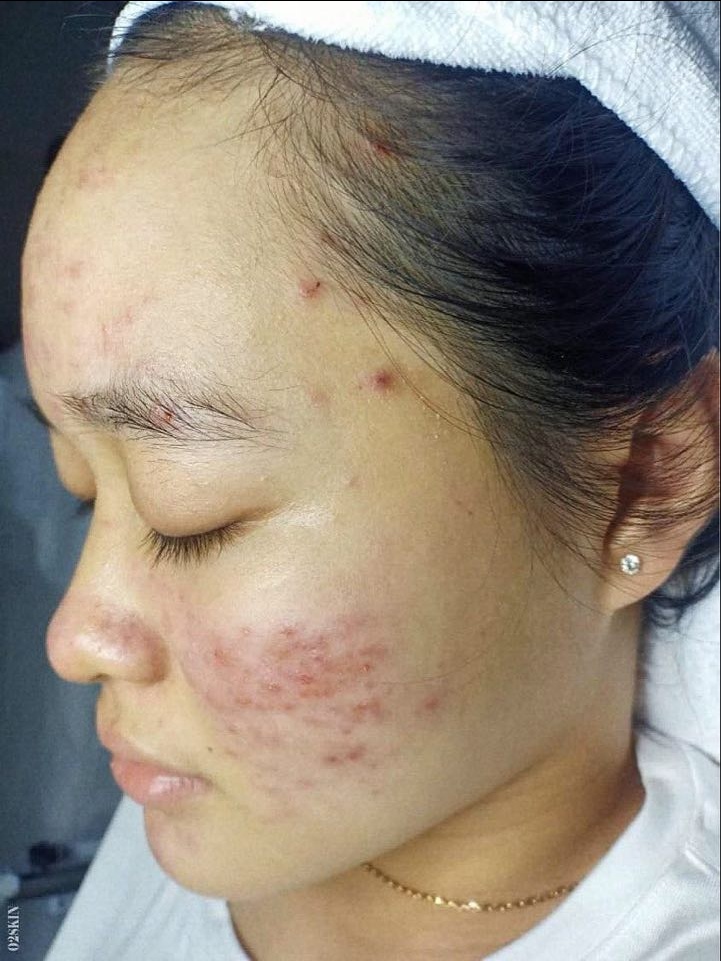 điều trị mụn ảnh 2 dieu tri mun anh 2