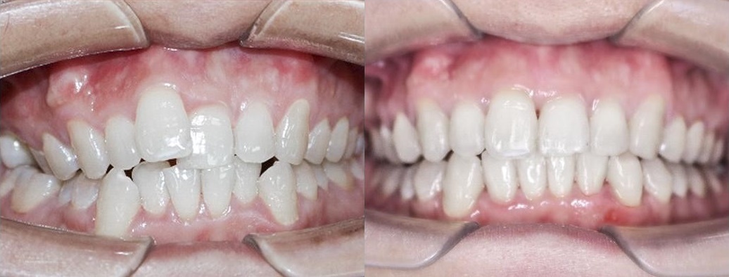 niềng răng trong suốt ảnh 3 nieng rang trong suot anh 3