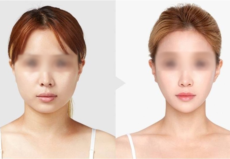 Ky thuat got ham V-line tai Benh vien tham my Gangwhoo hinh anh