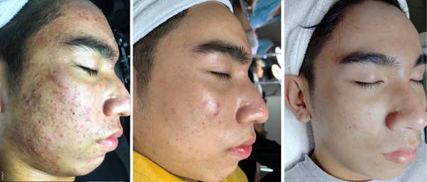 dieu tri mun,  mun trung ca anh 1