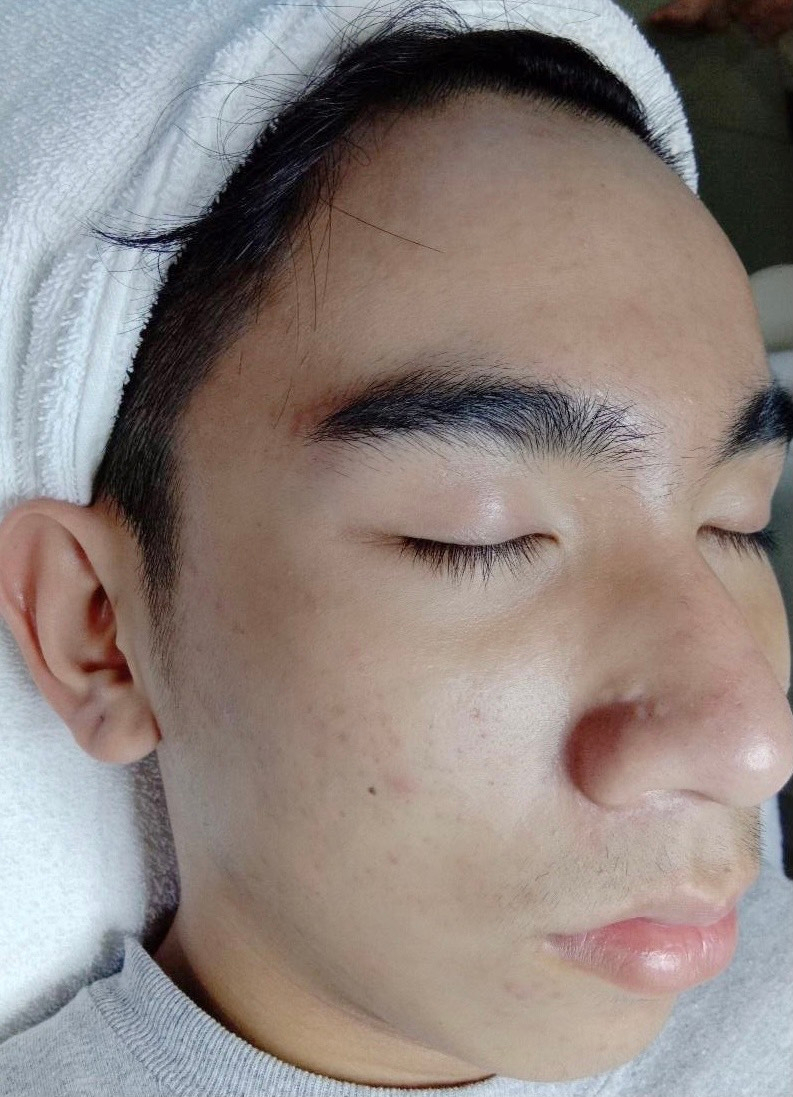 dieu tri mun,  mun trung ca anh 2