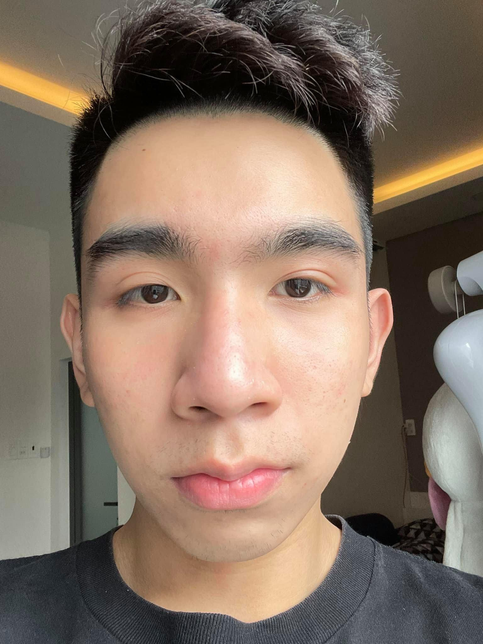 dieu tri mun,  mun trung ca anh 3