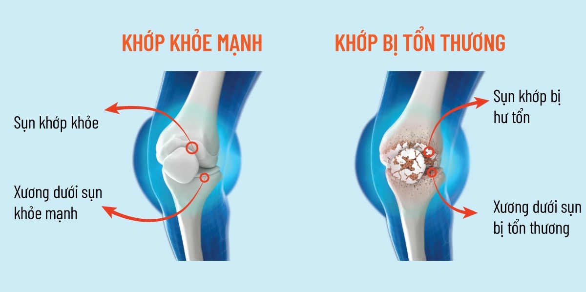 Jex,  thuc pham ho tro xuong khop anh 2