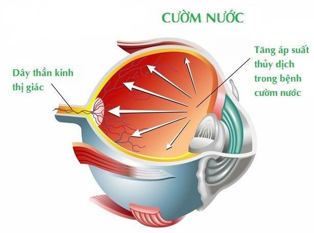nguy hiểm từ cườm nước ảnh 1 nguy hiem tu cuom nuoc anh 1