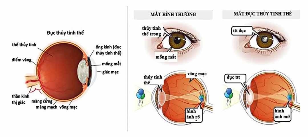 Đôi mắt sáng khỏe,  Santen ảnh 1 Doi mat sang khoe,  Santen anh 1