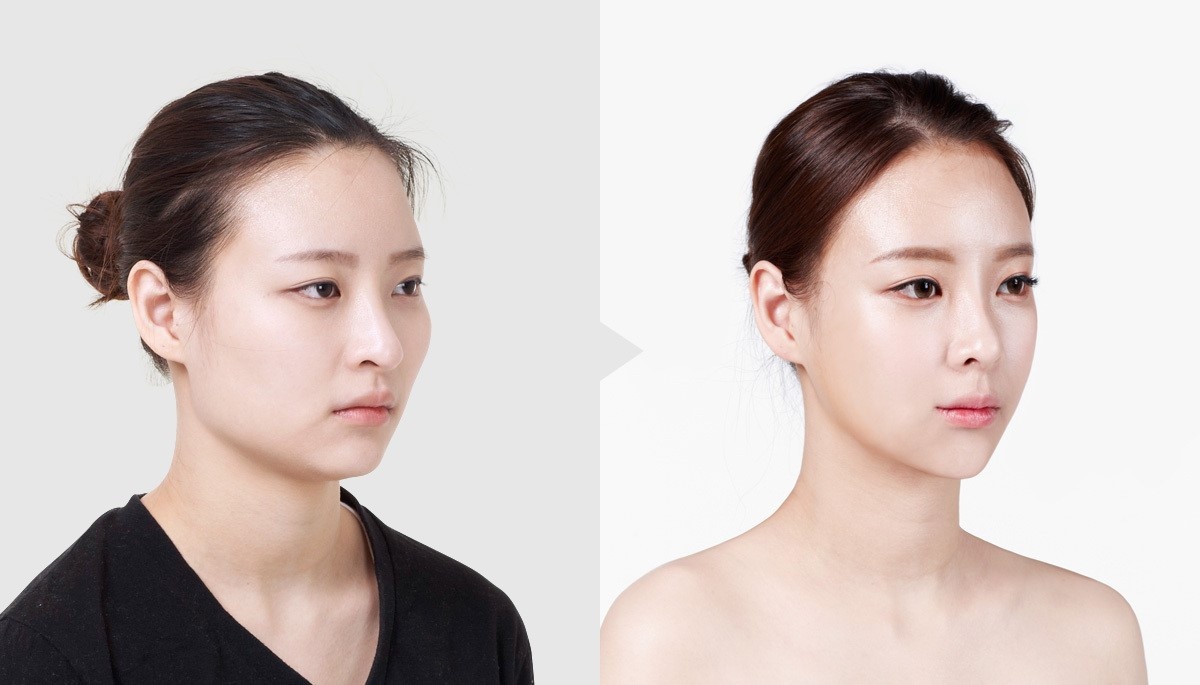 tiêm tạo hình ảnh 2 tiem tao hinh anh 2