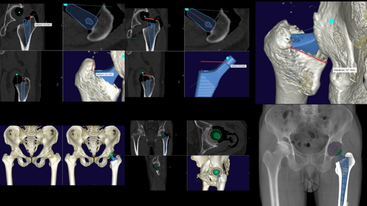Phau thuat khop hang anh 1