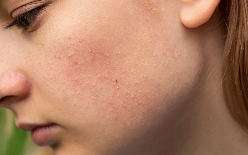 Nhung dieu can biet ve mun an hinh anh