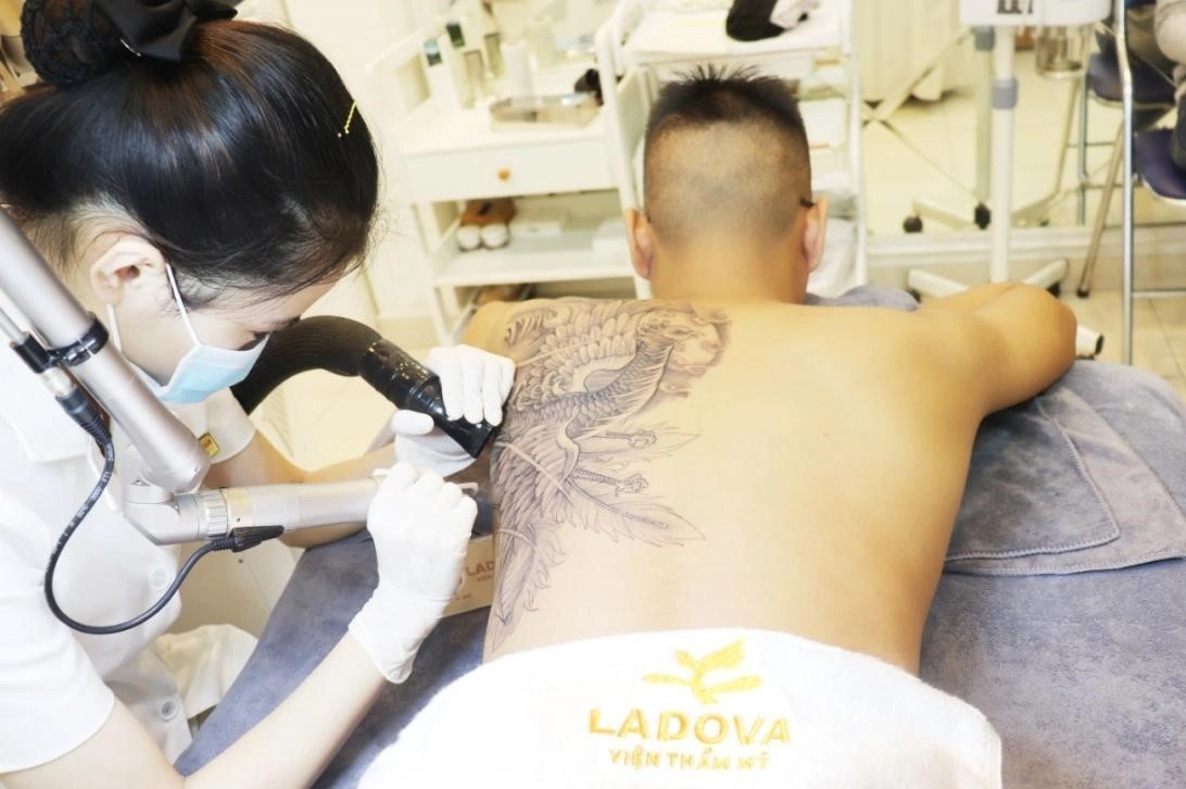 Xoa hinh xam bang cong nghe Alphatech Plus tu My hinh anh