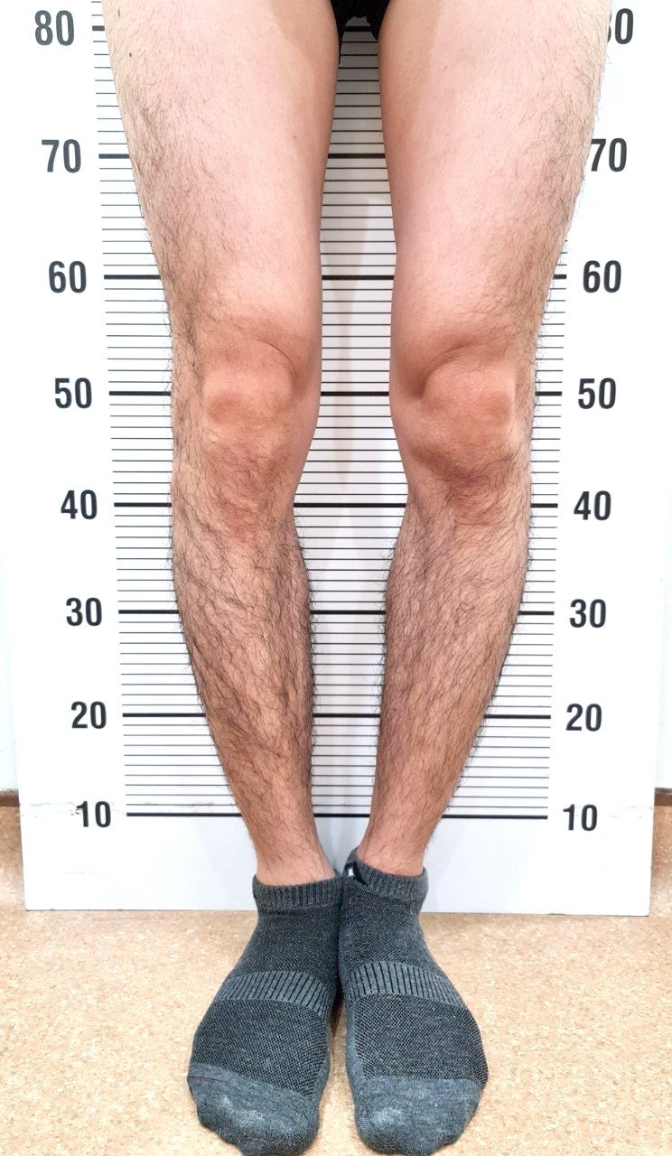 xuong khop,  phau thuat chan vong kieng anh 2