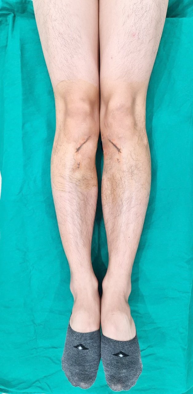 xuong khop,  phau thuat chan vong kieng anh 3