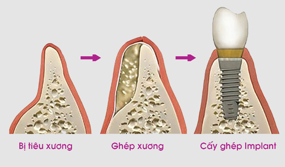 tieu xuong,  mat rang anh 2
