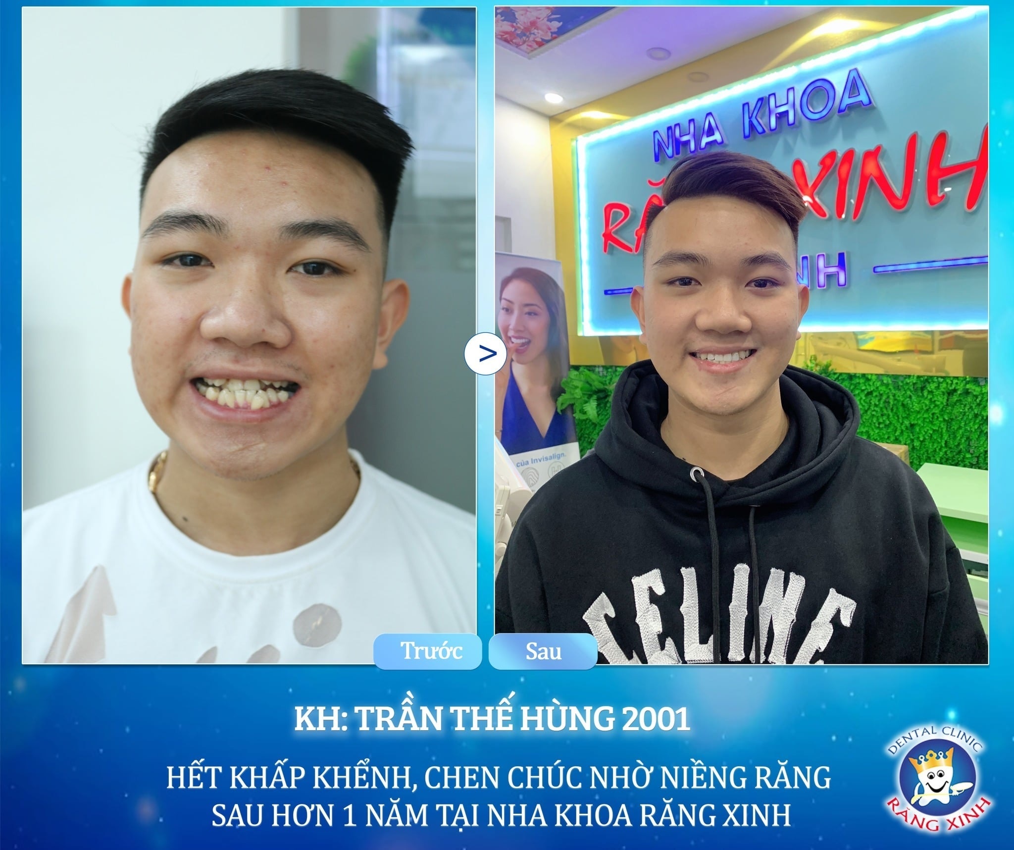 rang dep,  cham soc rang anh 2