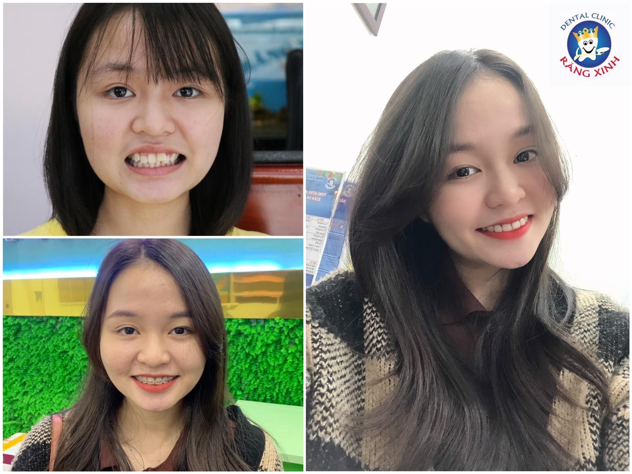 rang dep,  cham soc rang anh 3