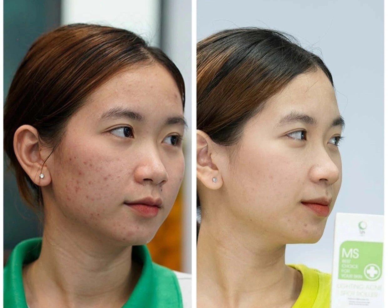 Lam mo tham mun voi thanh lan Ms Cosmetic hinh anh