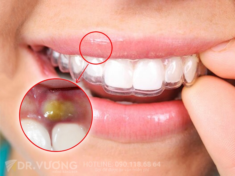 Dr. Vuong,  nieng rang trong suot anh 2