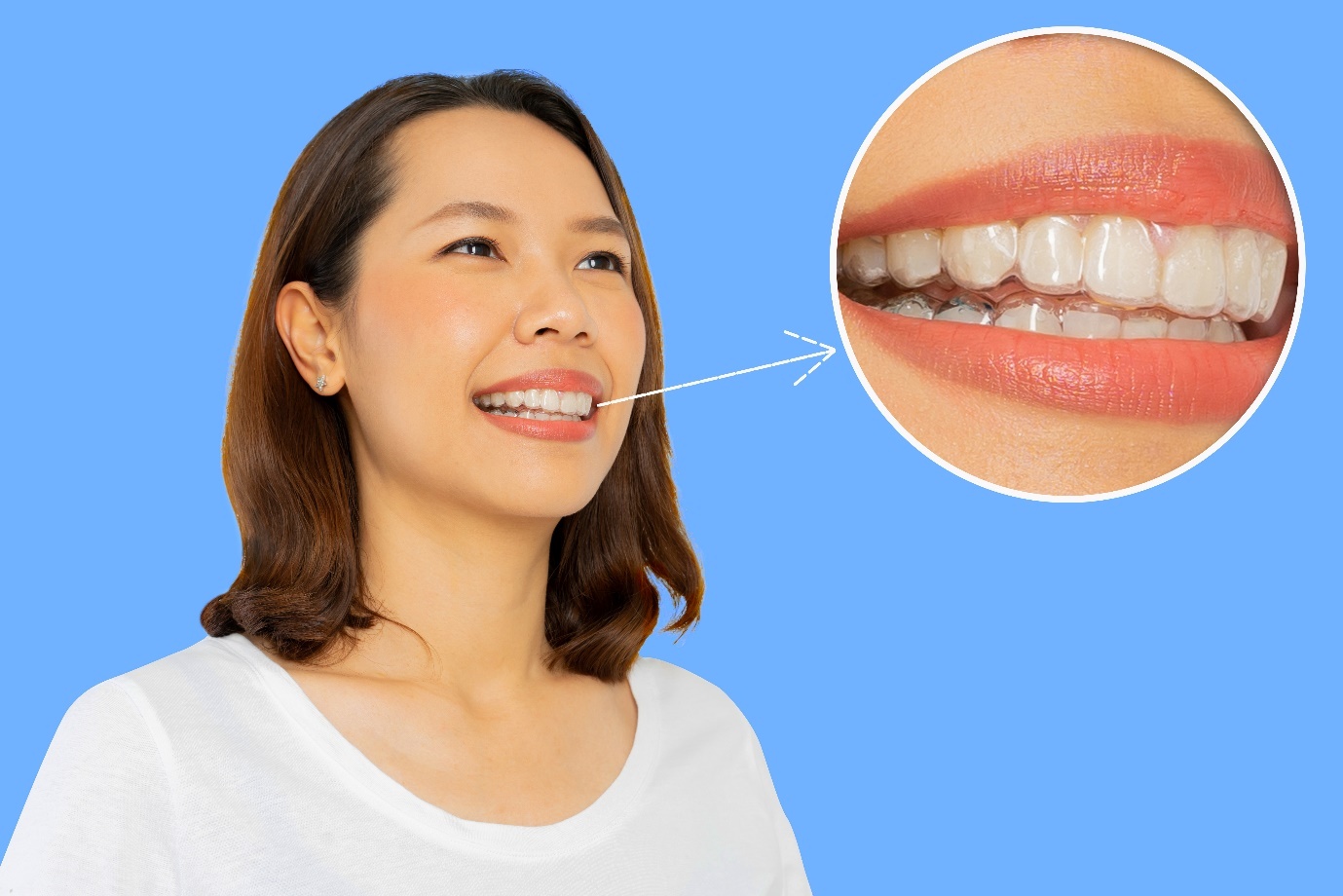 Dr. Vuong,  nieng rang trong suot anh 4