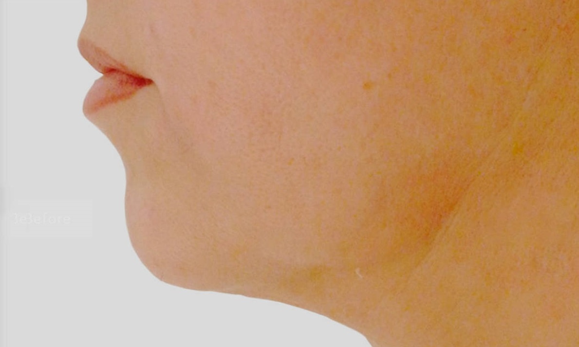 Tre hoa da voi cong nghe soi quang Endolift tu Italy hinh anh