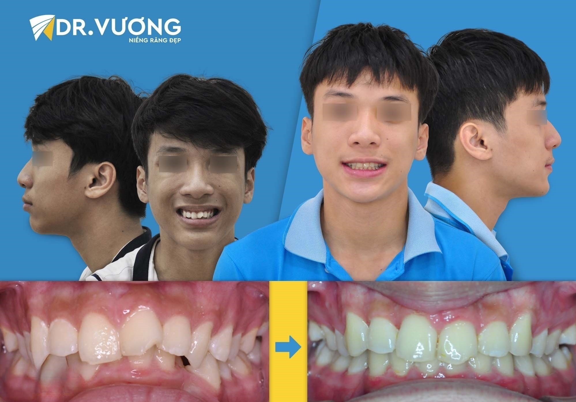 Niềng răng Dr Vương ảnh 3 Nieng rang Dr Vuong anh 3