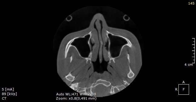 AZ Nose ảnh 2 AZ Nose anh 2