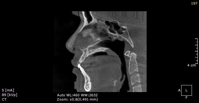 AZ Nose ảnh 3 AZ Nose anh 3