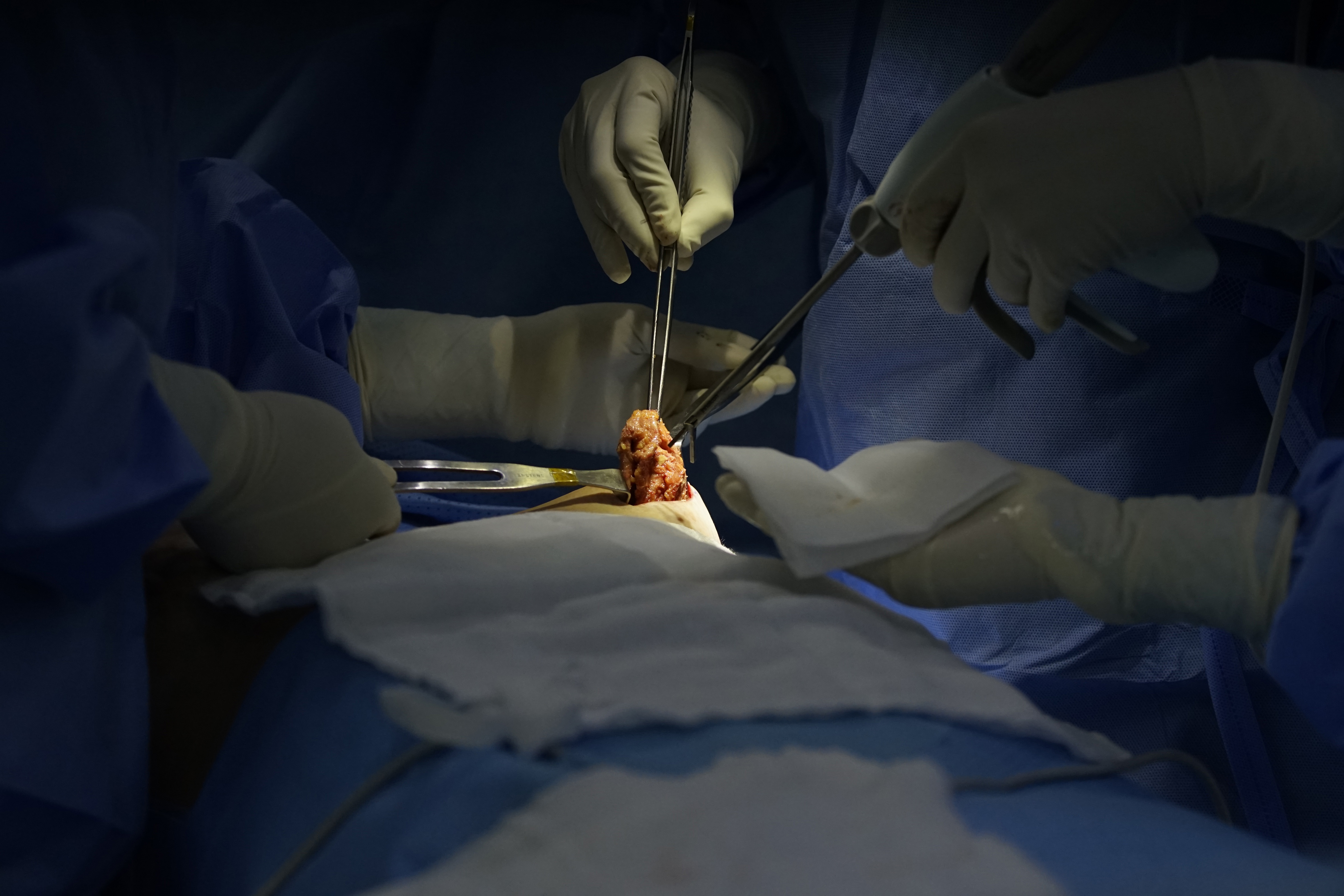 'Gia bao xo' sau nang nguc can tro do mem vong mot hinh anh