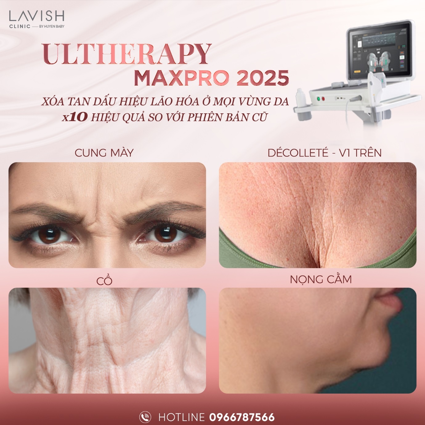 Ultherapy Prime MaxPro 2025,  Lavish Aesthetic Clinic anh 4