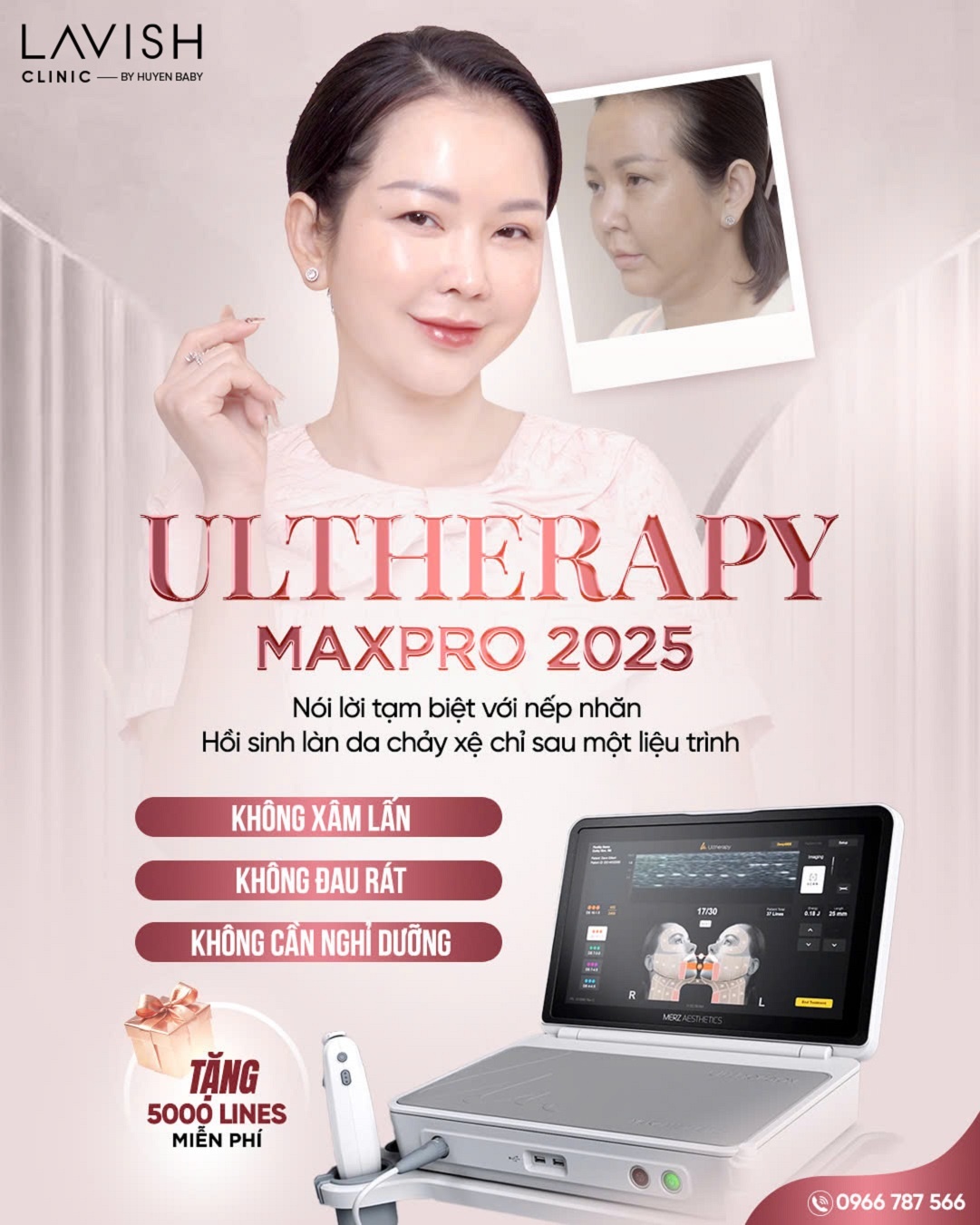 Ultherapy Prime MaxPro 2025,  Lavish Aesthetic Clinic anh 2