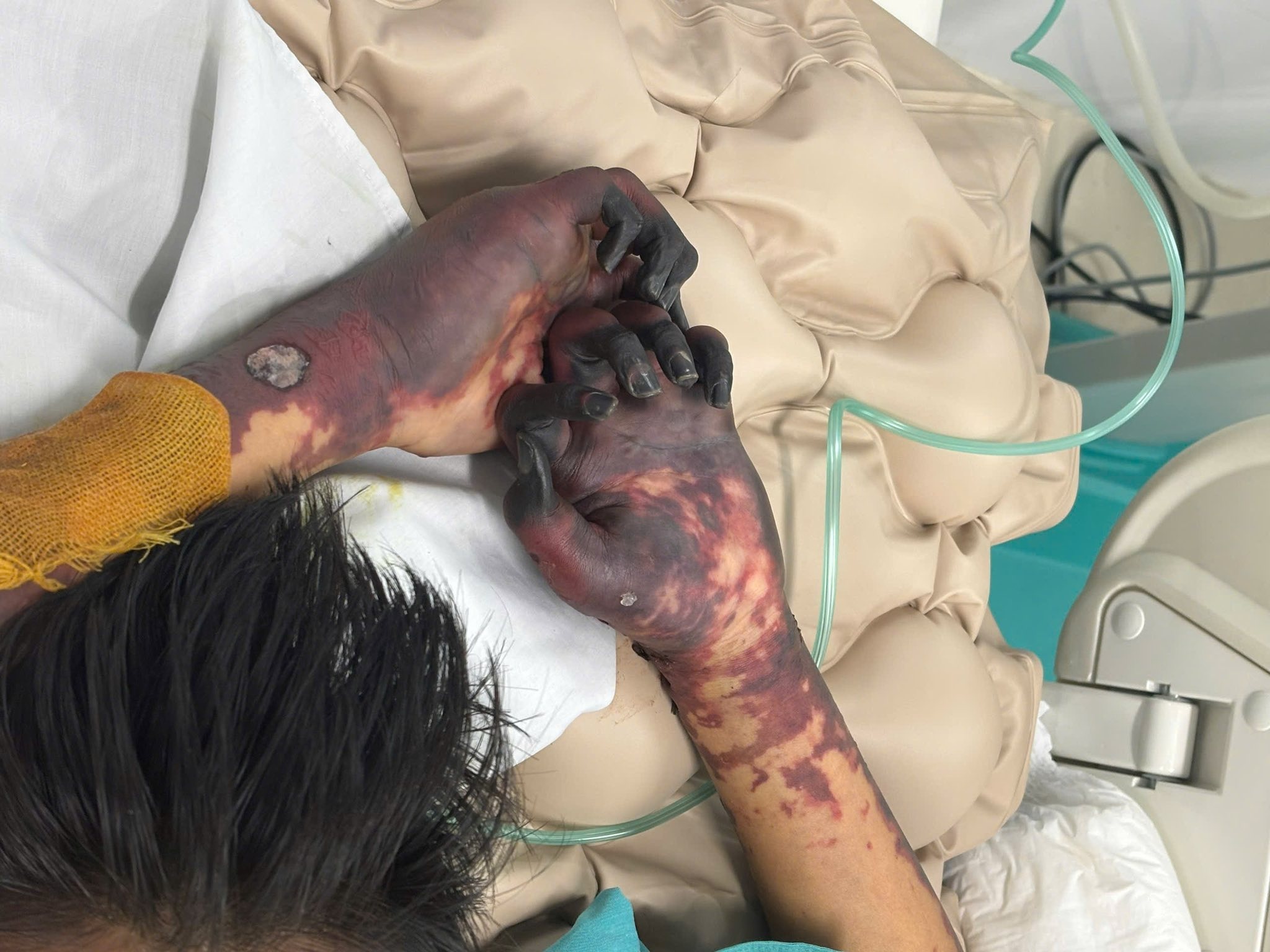 Bệnh do não mô cầu ảnh 3 Benh do nao mo cau anh 3