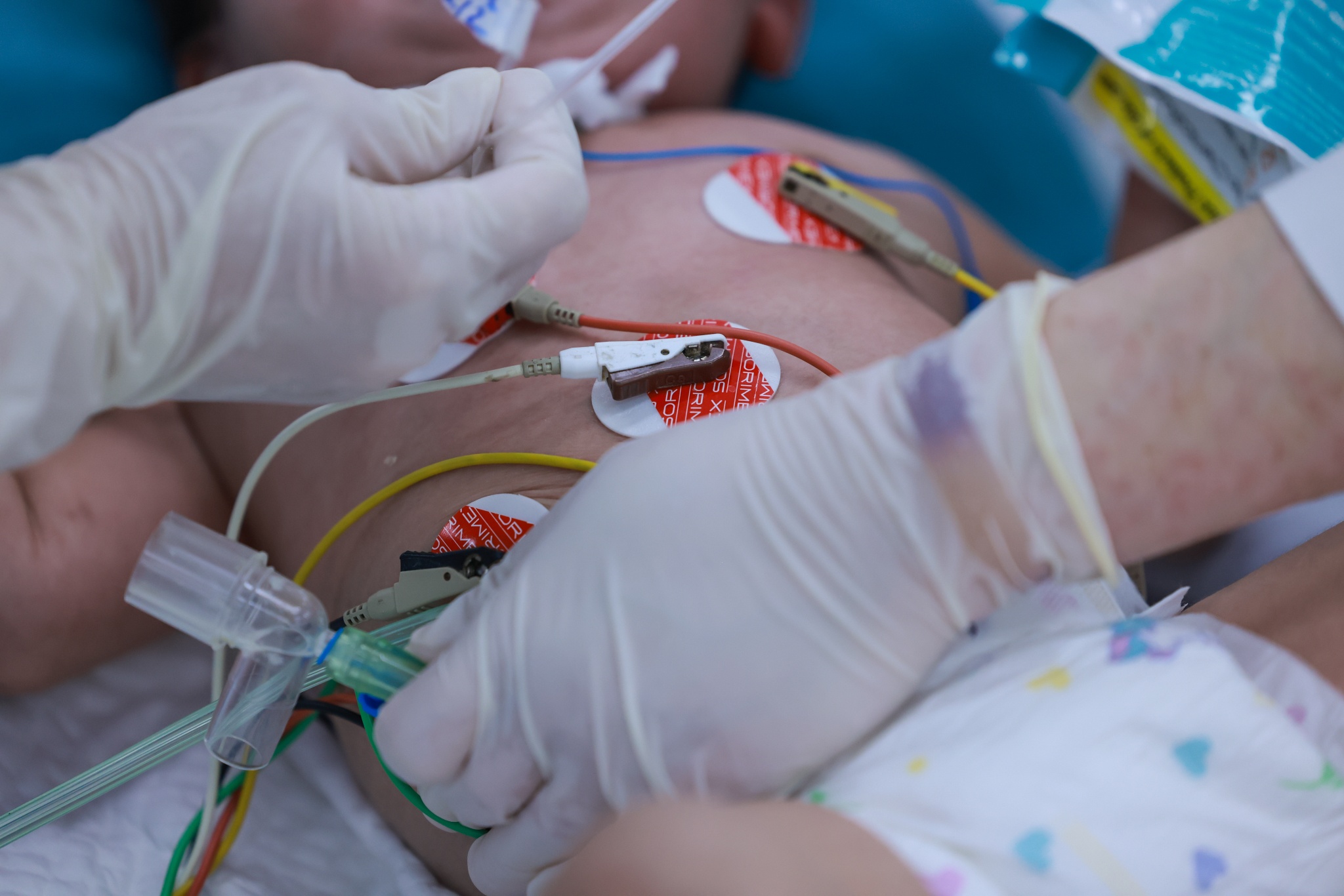 sốt xuất huyết ảnh 10 sot xuat huyet anh 10